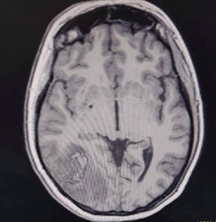 Tromb în cap: simptome, tratament, consecințe ale trombozei cerebrale