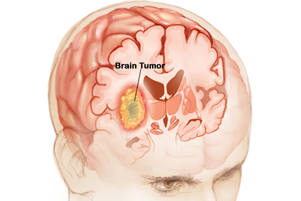 Tumorile cerebrale – simptome, diagnosticare, tratament
